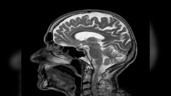 Cerebral aneurysm: What happens when the brain bleeds