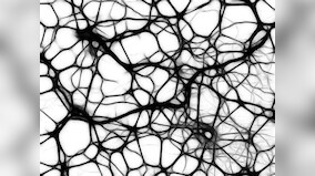 What is excitotoxicity, and what does it have to do with Huntington's disease?