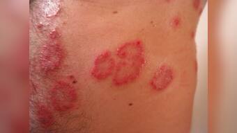 Top three myths about psoriasis, and the truth behind them