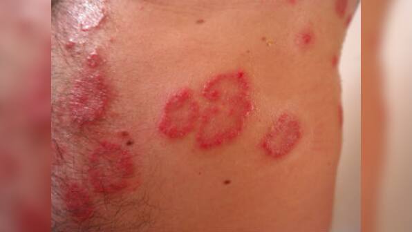 Top three myths about psoriasis, and the truth behind them