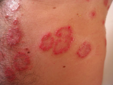Top three myths about psoriasis, and the truth behind them Top three myths about psoriasis, and the truth behind them