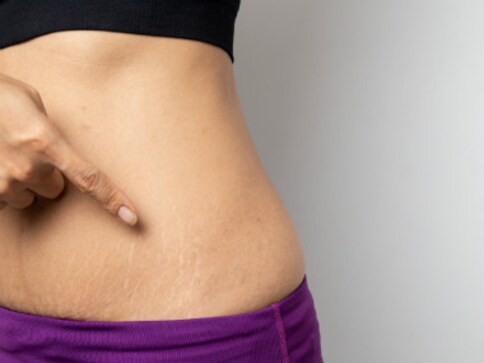 Those white lines on your tummy and thighs aren’t cellulitis Those white lines on your tummy and thighs aren’t cellulitis