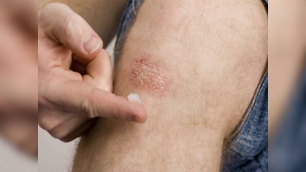 World Psoriasis Day 2019: Psoriasis and four other skin conditions that are not contagious