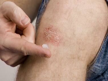 World Psoriasis Day 2019: Psoriasis and four other skin conditions that are not contagious