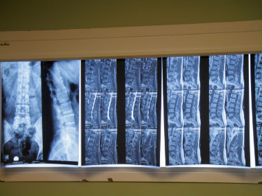 World Spine Day 2019: Everything you need to know about slipped disc, plus three exercises to strengthen the back World Spine Day 2019: Everything you need to know about slipped disc, plus three exercises to strengthen the back