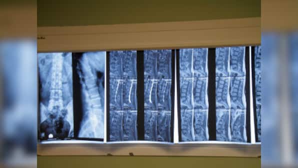 World Spine Day 2019: Everything you need to know about slipped disc, plus three exercises to strengthen the back