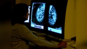 Breast Cancer Awareness Month: 12 different types of breast cancer - Part 3
