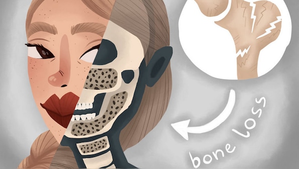 Osteoporosis affects an estimated 50 million Indians, but most cases go untreated, undiagnosed