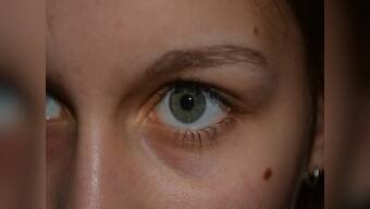 Most birthmarks can be harmless but some may need medical attention: Here's a guide to the various types of birthmarks