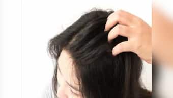 Scalp acne can be painful and irritating: All you need to know about its prevention, treatment and causes