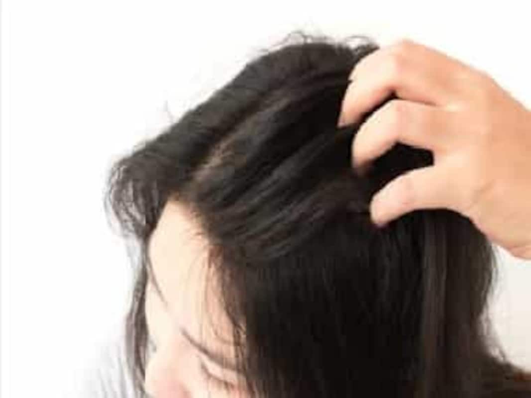 Scalp acne can be painful and irritating: All you need to know about its  prevention, treatment and causes-Health News , Firstpost