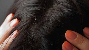 Dandruff raining on your face, chest or back? It might be seborrheic dermatitis