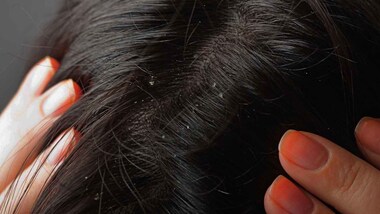 Dandruff raining on your face, chest or back? It might be seborrheic dermatitis