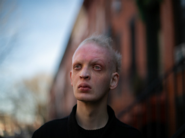 This life-threatening disease has all the signs we've come to associate with vampires This life-threatening disease has all the signs we've come to associate with vampires