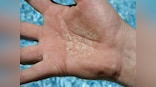 Experience: I didn’t shake hands for a year while dealing with Psoriasis