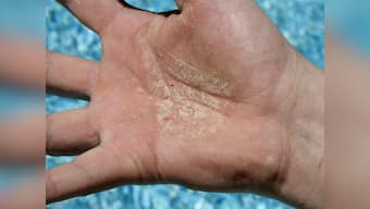 Experience: I didn’t shake hands for a year while dealing with Psoriasis