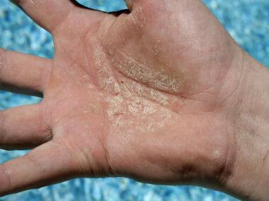 Experience: I didn’t shake hands for a year while dealing with Psoriasis