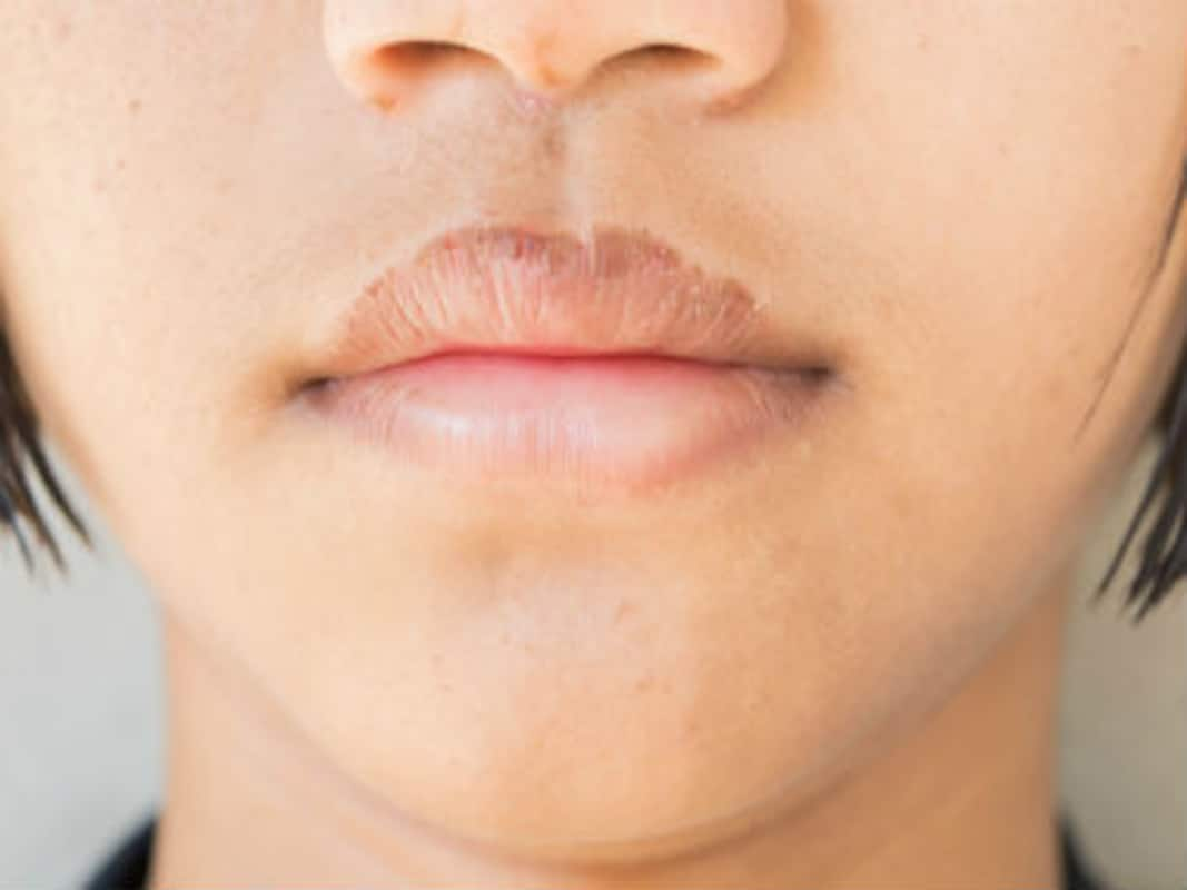 hypothyroidism-chapped-lips-lipstutorial