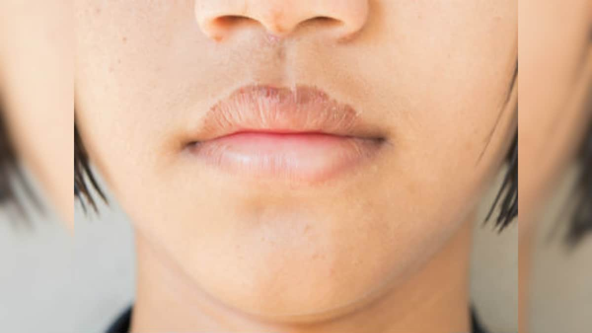 7 home remedies for chapped lips