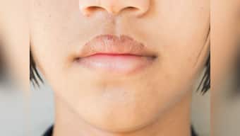 7 home remedies for chapped lips