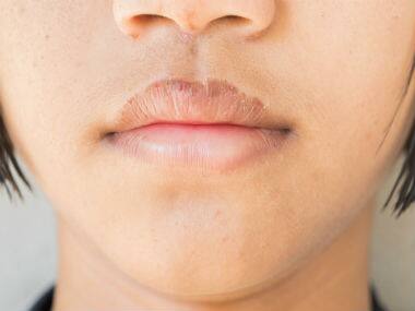 7 home remedies for chapped lips