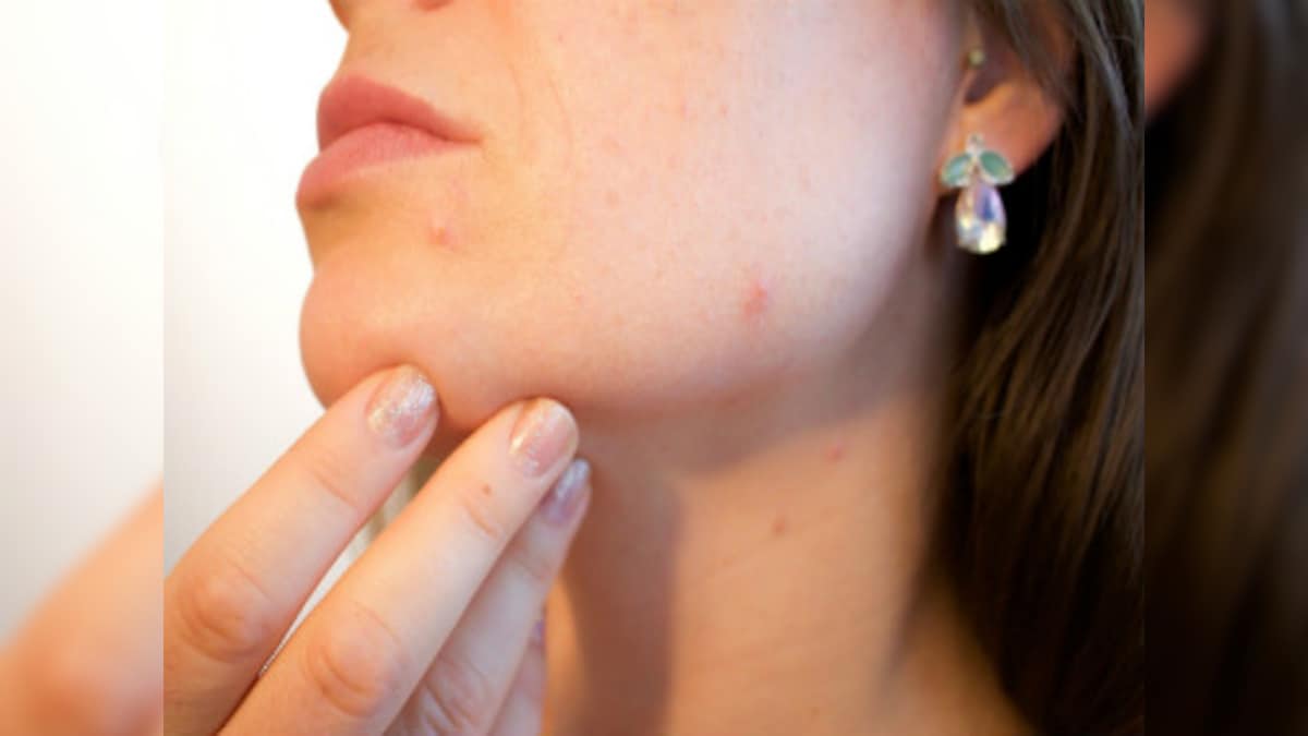 Four easy-peasy home remedies for acne