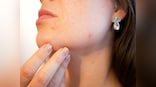 Four easy-peasy home remedies for acne