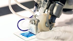 Handheld 3D printer can print skin cells on burn injuries too serious for skin graftin