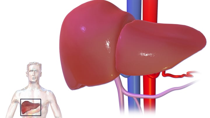 Number of liver cancer cases are rising around the world inspite of advances made in prevention