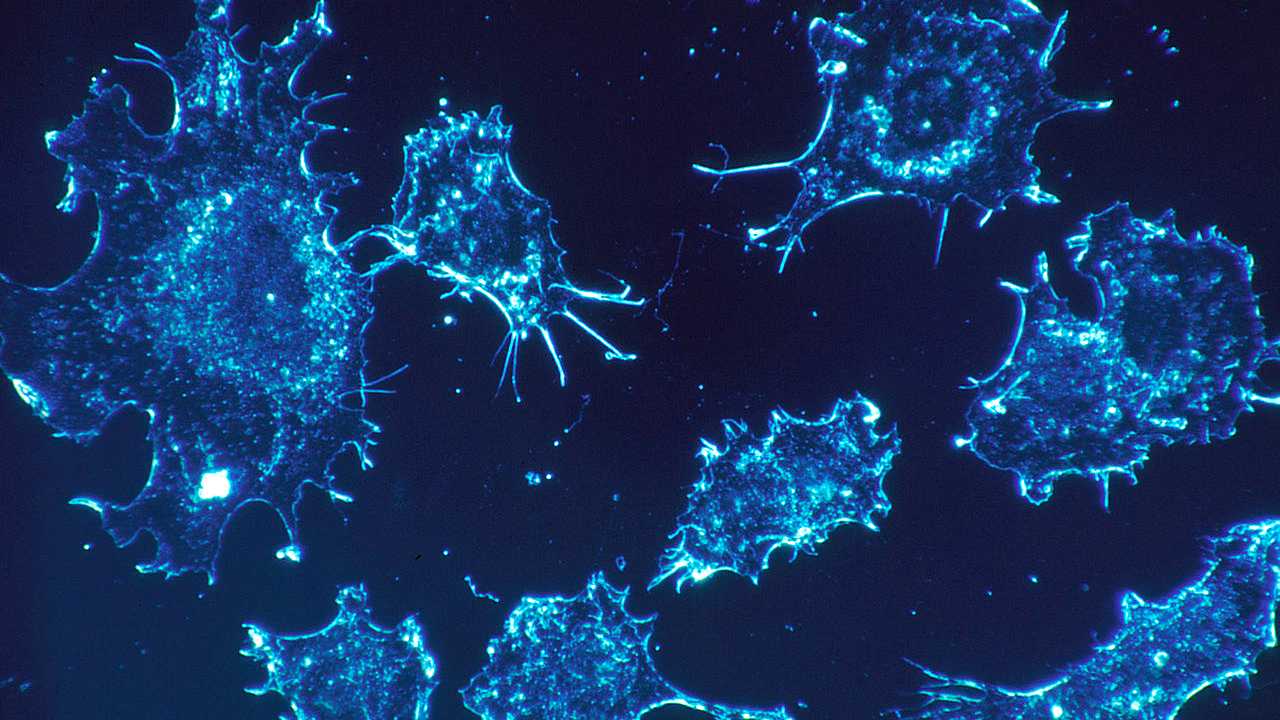 Cancer patients infected with Coronavirus are three times more likely to die: Study Cancer patients infected with Coronavirus are three times more likely to die: Study