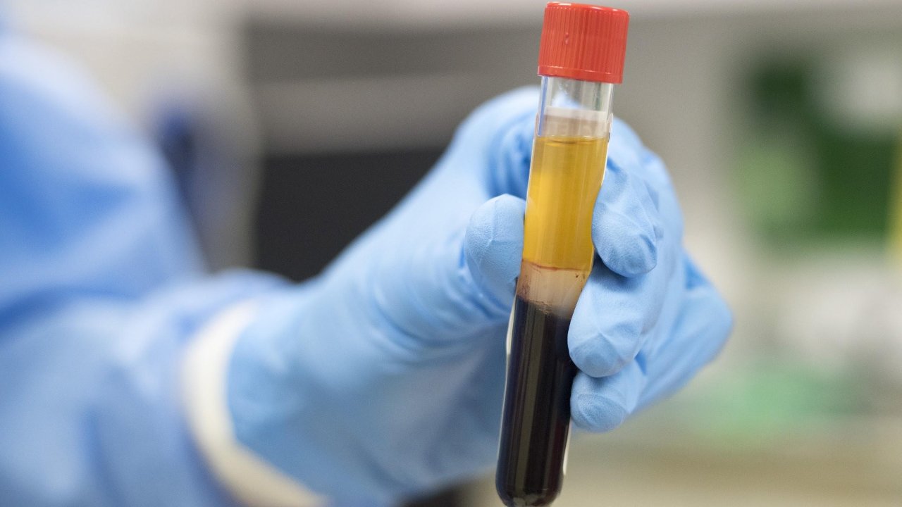 First Coronavirus patient to receive plasma therapy, recovers and taken off ventilator: Delhi hospital First Coronavirus patient to receive plasma therapy, recovers and taken off ventilator: Delhi hospital