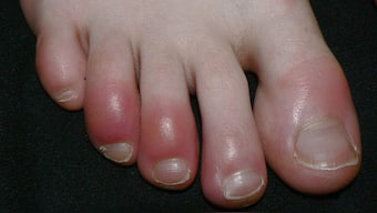 What is ‘COVID Toe’? Is this another strange symptoms of the Coronavirus infection?