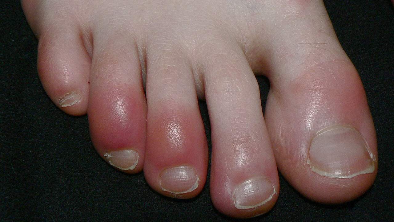 What is ‘COVID Toe’? Is this another strange symptoms of the Coronavirus infection? What is ‘COVID Toe’? Is this another strange symptoms of the Coronavirus infection?
