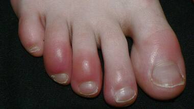 What is ‘COVID Toe’? Is this another strange symptoms of the Coronavirus infection?