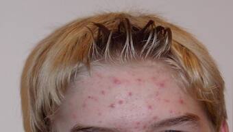 Diet and adult acne: New study shows how they’re connected and which food to avoid
