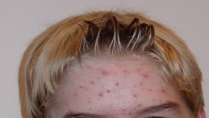 Diet and adult acne: New study shows how they’re connected and which food to avoid