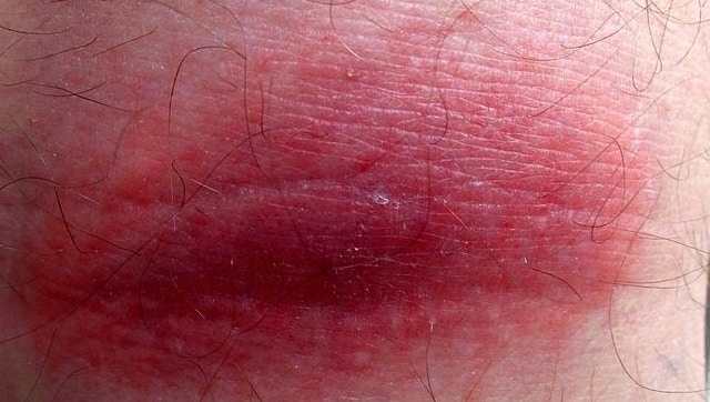 Spices, green tea, fatty fish among key foods that help fight inflammation naturally in the body Spices, green tea, fatty fish among key foods that help fight inflammation naturally in the body