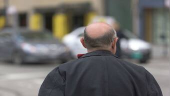 People with male pattern baldness may be more susceptible to severe COVID-19, says study by Spanish researchers