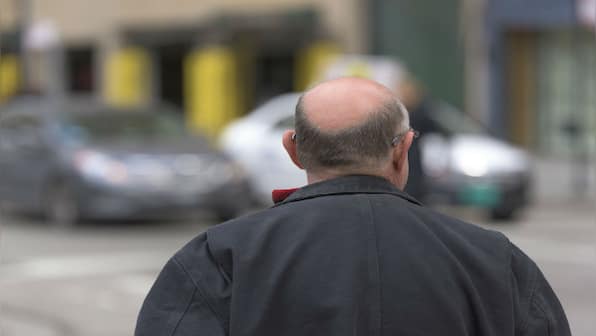 People with male pattern baldness may be more susceptible to severe COVID-19, says study by Spanish researchers