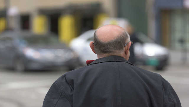 People with male pattern baldness may be more susceptible to severe COVID-19, says study by Spanish researchers People with male pattern baldness may be more susceptible to severe COVID-19, says study by Spanish researchers