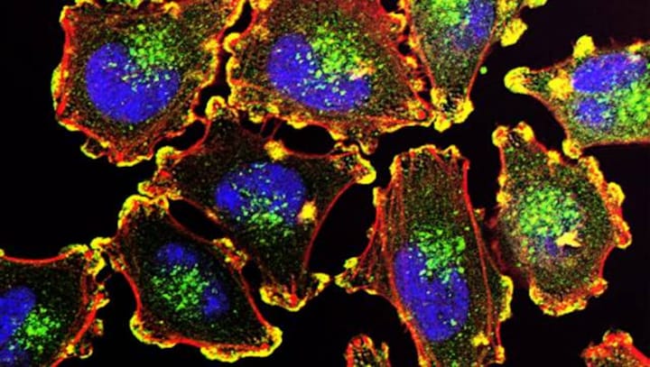 Canadian researchers reveal they might be able to stop cancer from becoming drug resistant by restricting lipid synthesis