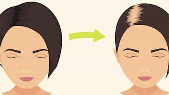 Hair loss therapy: New study suggests microRNA based products may work better than existing regeneration treatments
