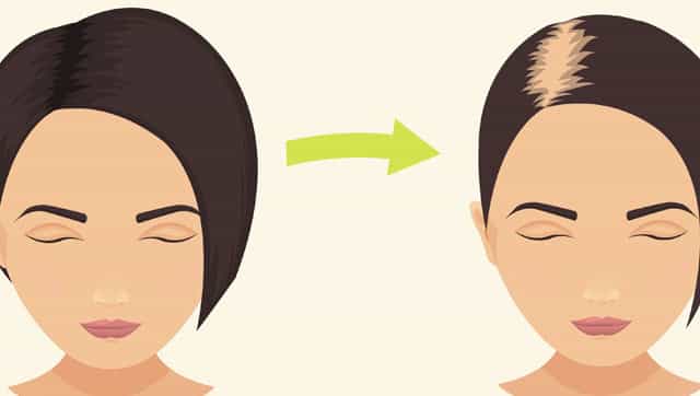 Monsoons can cause hair fall but paying attention to diet can help prevent it Monsoons can cause hair fall but paying attention to diet can help prevent it