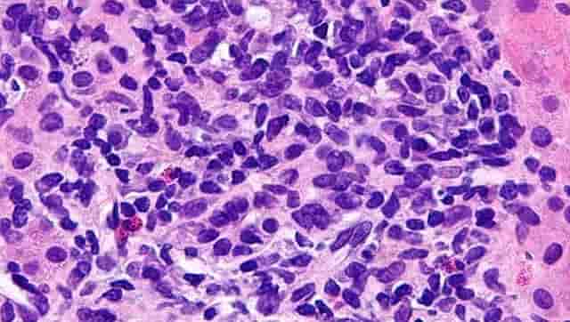 World Hepatitis day 2020: Awareness key to prevent liver disease; B and C variants most common causes of death World Hepatitis day 2020: Awareness key to prevent liver disease; B and C variants most common causes of death