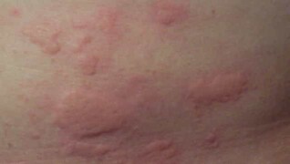 Are hives symptoms of covid