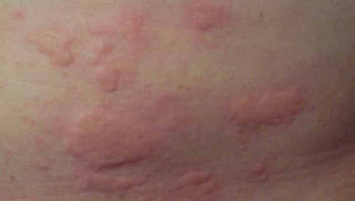 rash on skin