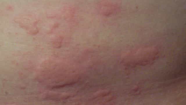 Skin rash a likely symptom of COVID-19 infection in untested symptomatic patients, claims study Skin rash a likely symptom of COVID-19 infection in untested symptomatic patients, claims study