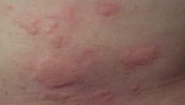 Skin rash a likely symptom of COVID-19 infection in untested symptomatic patients, claims study