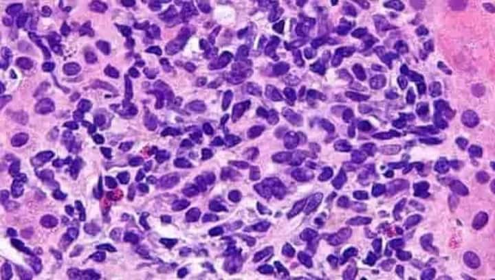 Antibodies found in natural controllers, mutation in virus structure can help control Hepatitis B, studies show