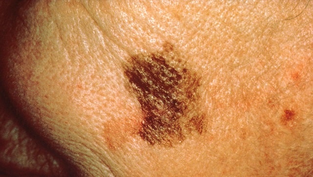 A new way to monitor skin cancer: Scientists suggest a urine test could help track progression and treatment response A new way to monitor skin cancer: Scientists suggest a urine test could help track progression and treatment response